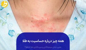 حساسیت به طلا چیست؟ راه‌های درمان آلرژی طلا